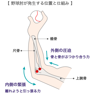 野球肘とは?